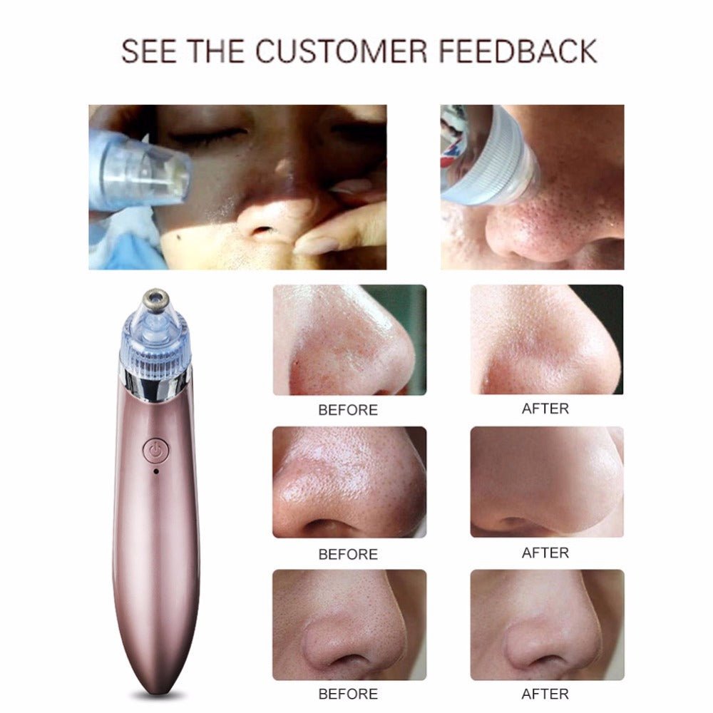 Comedone Vacuum Pro - I Want It